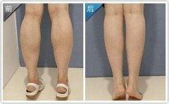 成都打注射瘦脸瘦小腿要多少钱