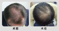 成都毛发种植多少钱
