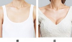 假体隆胸术后应该怎样保养