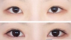 开眼角手术后该怎么护理 开眼角手术后该怎么护理