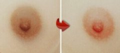 乳头乳晕漂红有哪些方法