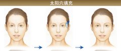 自体脂肪填充术后有哪些注意事项