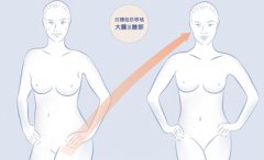 自体脂肪移植有什么优势 自体脂肪移植有什么优势