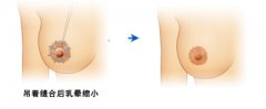 乳晕缩小术优势有哪些