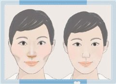 颧骨整形术后怎么护理