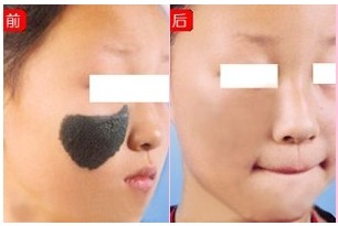 激光去胎记术前的注意事项有哪些