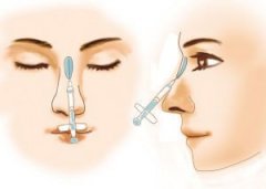 玻尿酸注射隆鼻之后鼻子会肿胀吗
