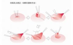 女性乳头内陷的原因是什么 女性乳头内陷怎么办