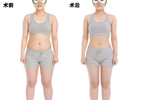 全身抽脂多少钱受哪些因素影响 全身抽脂多少钱与哪些因素有关