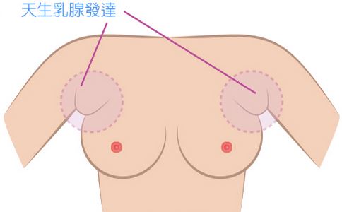 做副乳手术需要多少钱 副乳手术需要多少钱与哪些因素有关