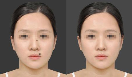 激光点痣之后要注意什么　药水点痣之后要注意什么