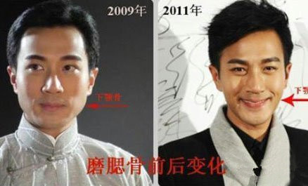 娱乐圈那些男士下颌角整形的成功案例