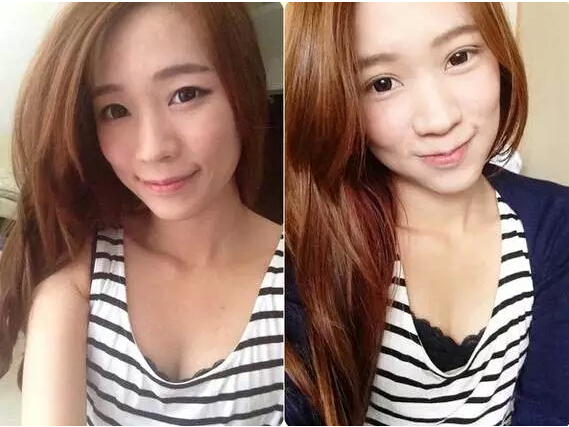 【欧式双眼皮】欧式双眼皮对比照片