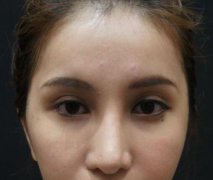 【开眼角前后对比照片】开眼角前后对比图 【开眼角前后对比照片】开眼角前后对比图