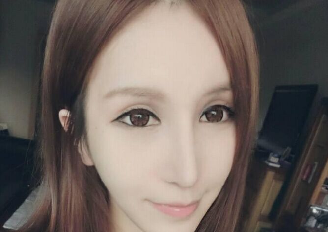 【开眼角前后对比照片】开眼角前后对比图
