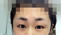 【开眼角疼不疼】开眼角后遗症