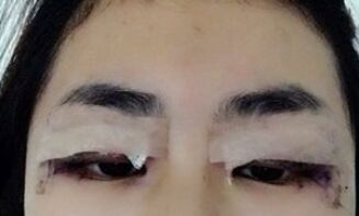 【开眼角疼不疼】开眼角后遗症