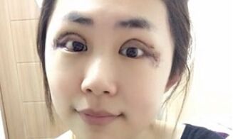 【开眼角疼不疼】开眼角后遗症