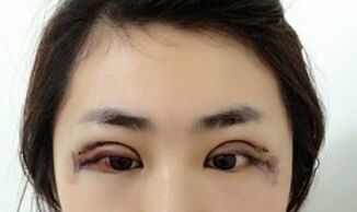 【开眼角疼不疼】开眼角后遗症
