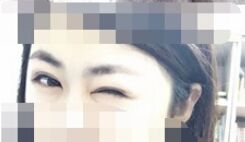 【开眼角疼不疼】开眼角后遗症