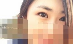 【开眼角疼不疼】开眼角后遗症