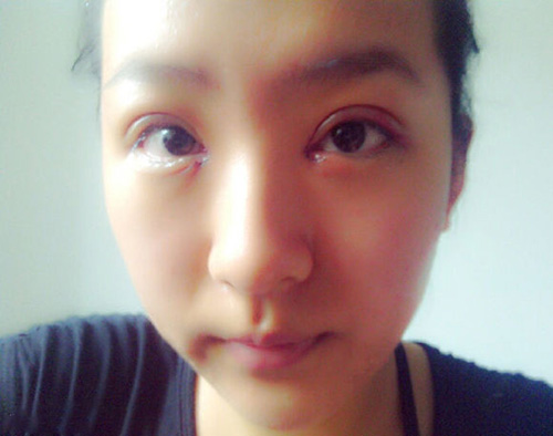 【开眼角手术医院】开眼角手术哪个医院好
