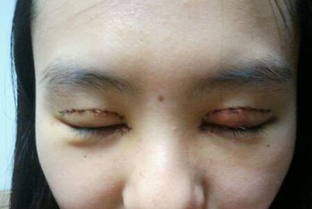 开眼角手术费用