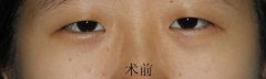 开眼角手术痛吗?开眼角后遗症?开眼角恢复期? 开眼角手术痛吗?开眼角后遗症?开眼角恢复期?