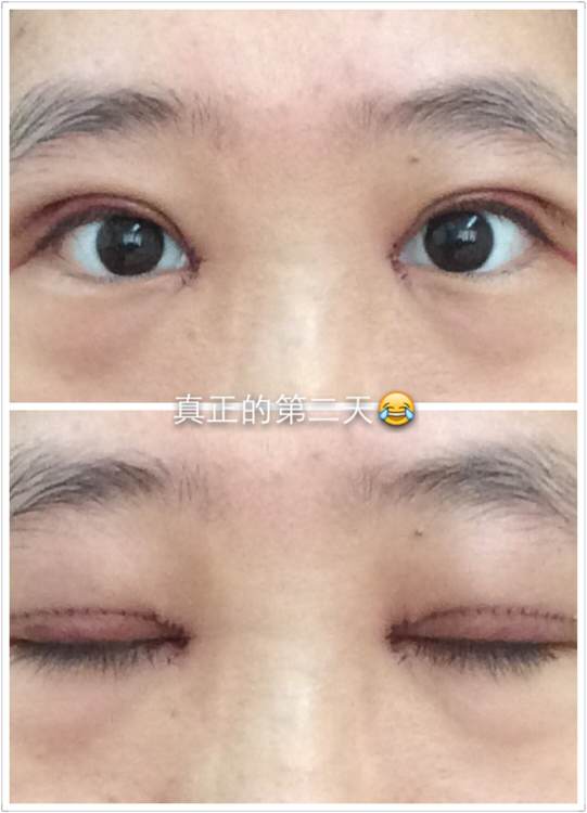 开眼角手术痛吗?开眼角后遗症?开眼角恢复期?