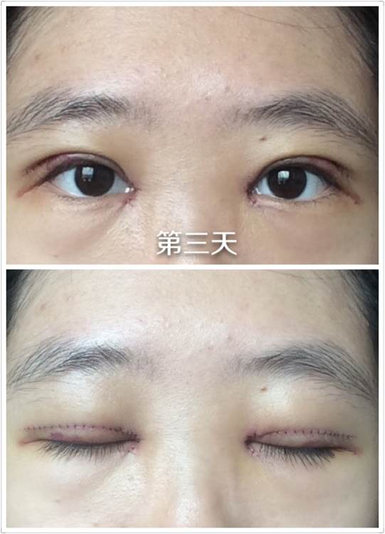 开眼角手术痛吗?开眼角后遗症?开眼角恢复期?