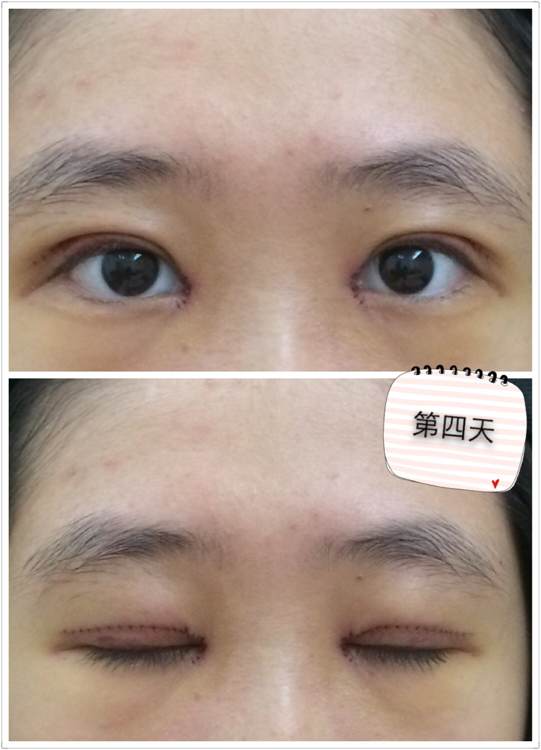 开眼角手术痛吗?开眼角后遗症?开眼角恢复期?