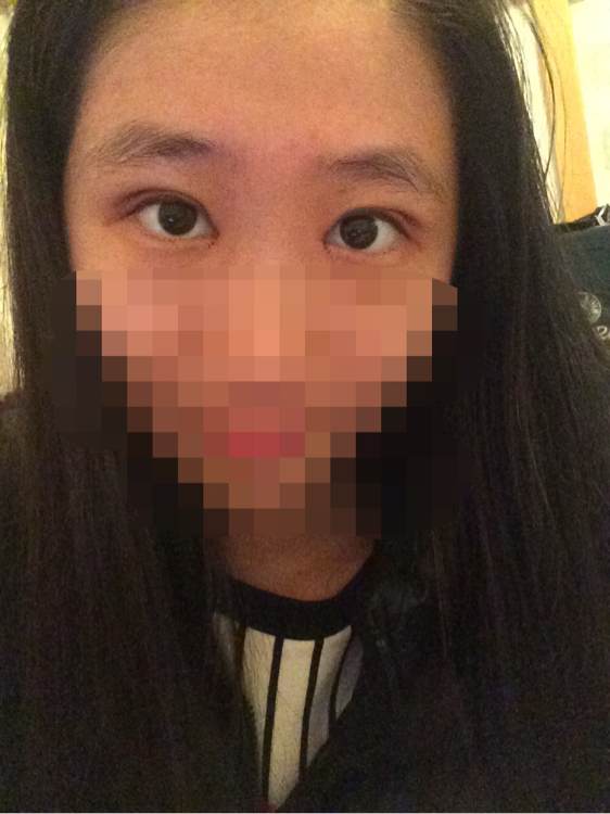 开眼角手术痛吗?开眼角后遗症?开眼角恢复期?