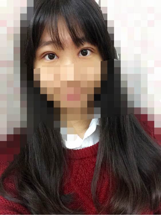 开眼角手术痛吗?开眼角后遗症?开眼角恢复期?