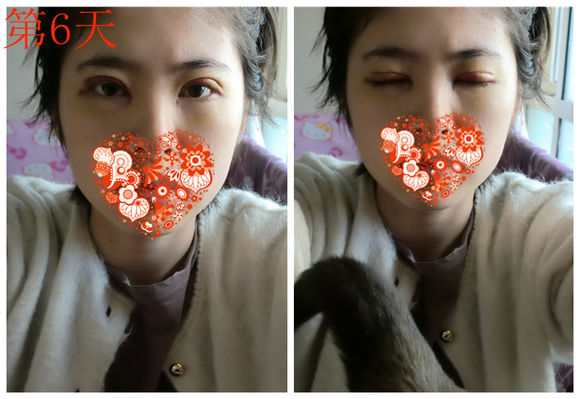 【开眼角手术前后对比】开眼角风险大吗,开眼角整形手术多少钱?