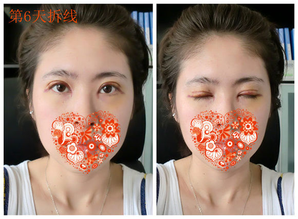【开眼角手术前后对比】开眼角风险大吗,开眼角整形手术多少钱?