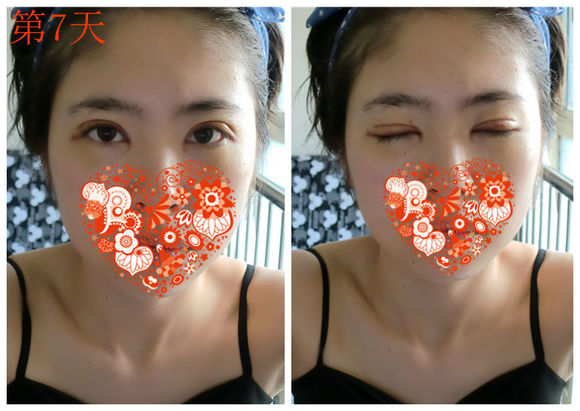 【开眼角手术前后对比】开眼角风险大吗,开眼角整形手术多少钱?