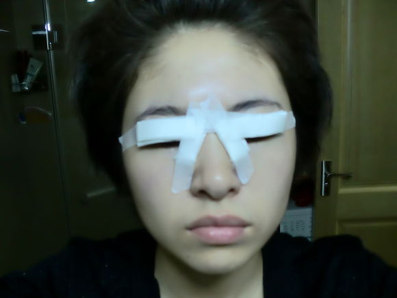 【开眼角手术前后对比】开眼角风险大吗,开眼角整形手术多少钱?