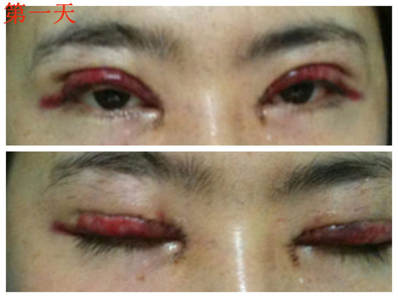 【开眼角手术前后对比】开眼角风险大吗,开眼角整形手术多少钱?