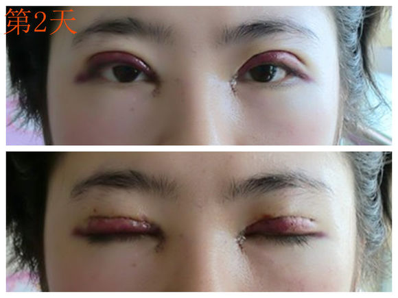 【开眼角手术前后对比】开眼角风险大吗,开眼角整形手术多少钱?