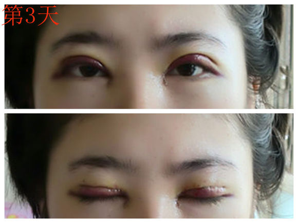 【开眼角手术前后对比】开眼角风险大吗,开眼角整形手术多少钱?