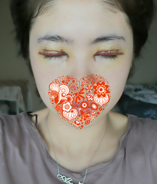 【开眼角手术前后对比】开眼角风险大吗,开眼角整形手术多少钱?