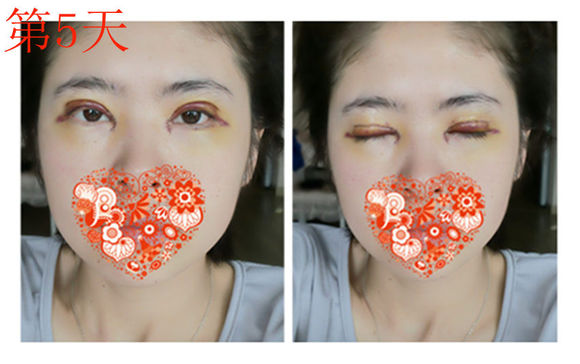 【开眼角手术前后对比】开眼角风险大吗,开眼角整形手术多少钱?