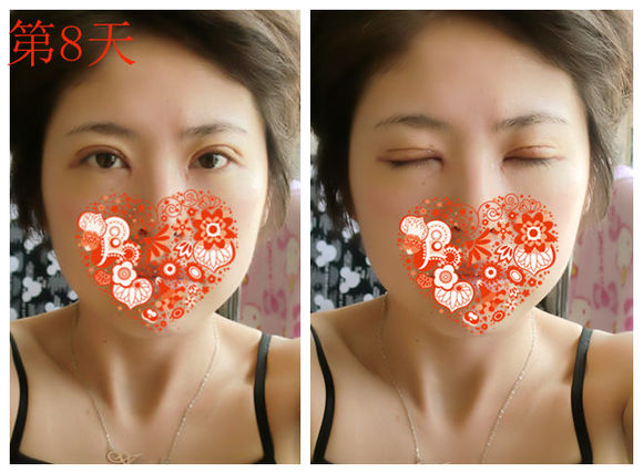 【开眼角手术前后对比】开眼角风险大吗,开眼角整形手术多少钱?