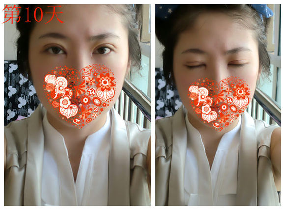 【开眼角手术前后对比】开眼角风险大吗,开眼角整形手术多少钱?