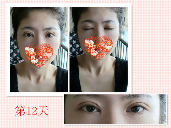 【开眼角手术前后对比】开眼角风险大吗,开眼角整形手术多少钱?