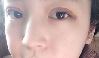 【压线双眼皮】压线双眼皮是永.久的吗?
