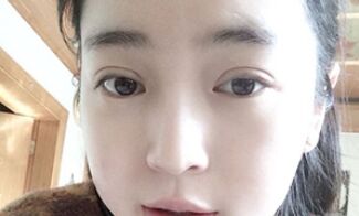 【压线双眼皮】压线双眼皮是永.久的吗?