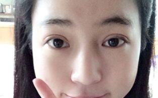 【压线双眼皮】压线双眼皮是永.久的吗?