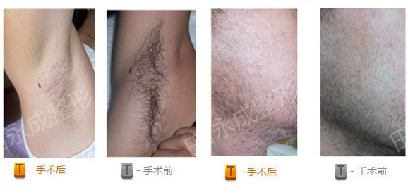 半导体冰点脱毛有什么优势 半导体冰点脱毛前后对比图