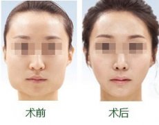女人尖下颌角整形手术怎么样 女人尖下颌角整形手术前后对比图